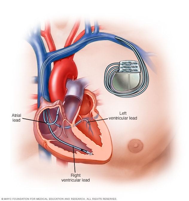 جهاز تنظيم ضربات القلب Mayo Clinic مايو كلينك