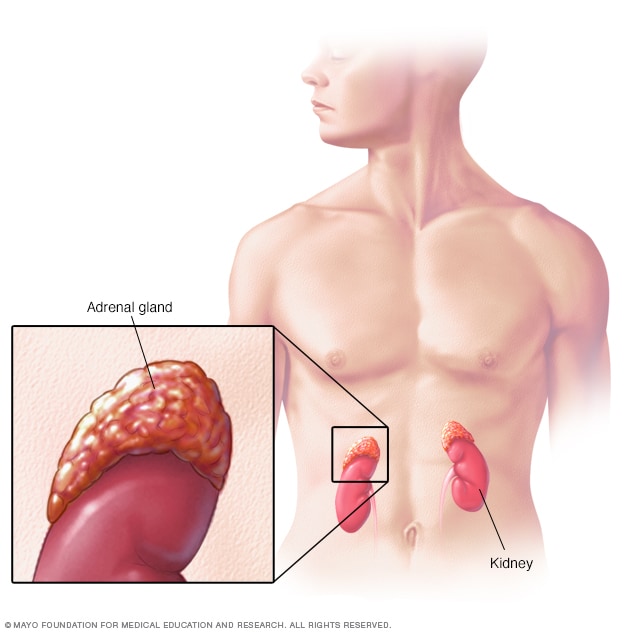 ورم أرومي عصبي الأعراض والأسباب mayo clinic مايو كلينك