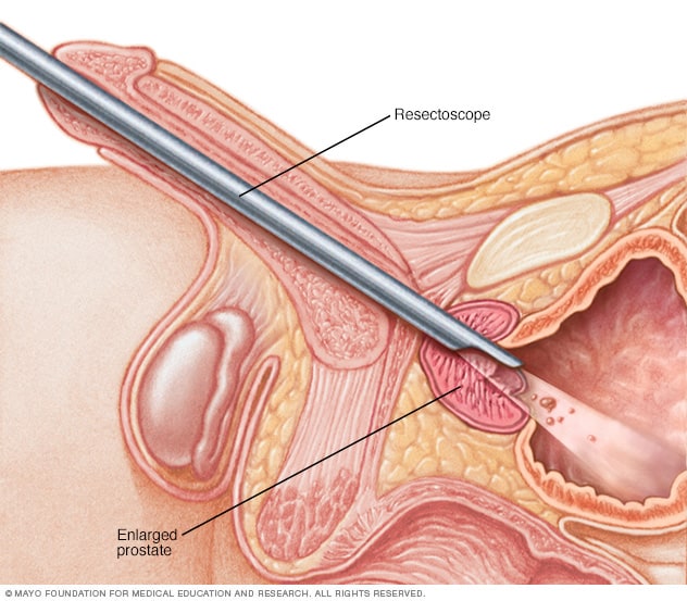 طريقة إجراء عملية إزالة أنسجة البروستاتا الزائدة جراحيًا