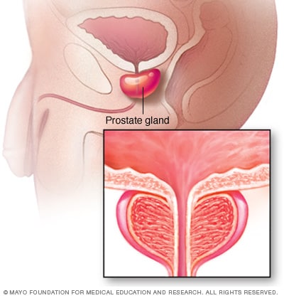 prostate gland surgery