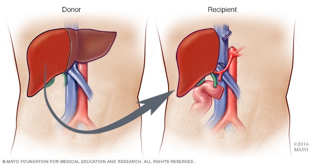 إجراء جراحة زراعة الكبد من متبرع حي