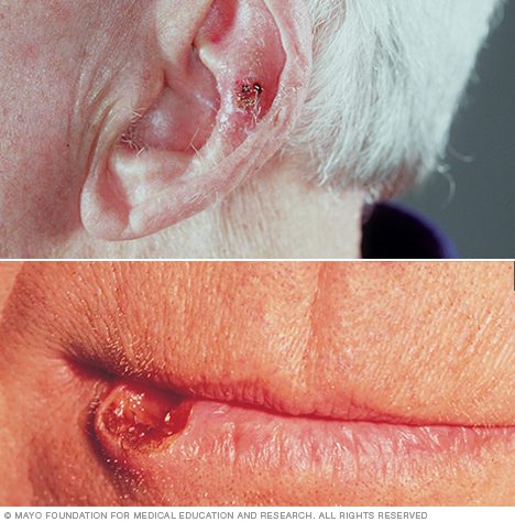سرطان الخلايا الحرشفية في الأذن والشفاه 