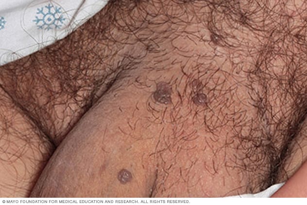 الثآليل التناسلية الأعراض والأسباب mayo clinic مايو كلينك