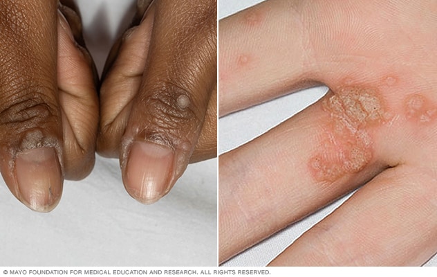 human papillomavirus causes)