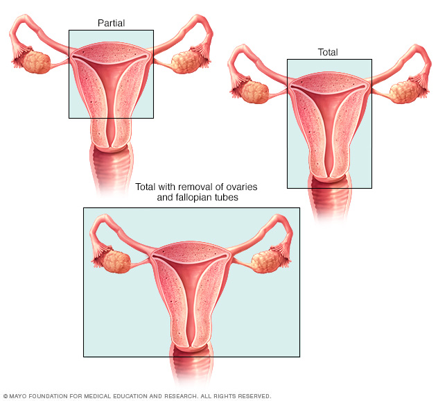 استئصال الرحم في البطن Mayo Clinic