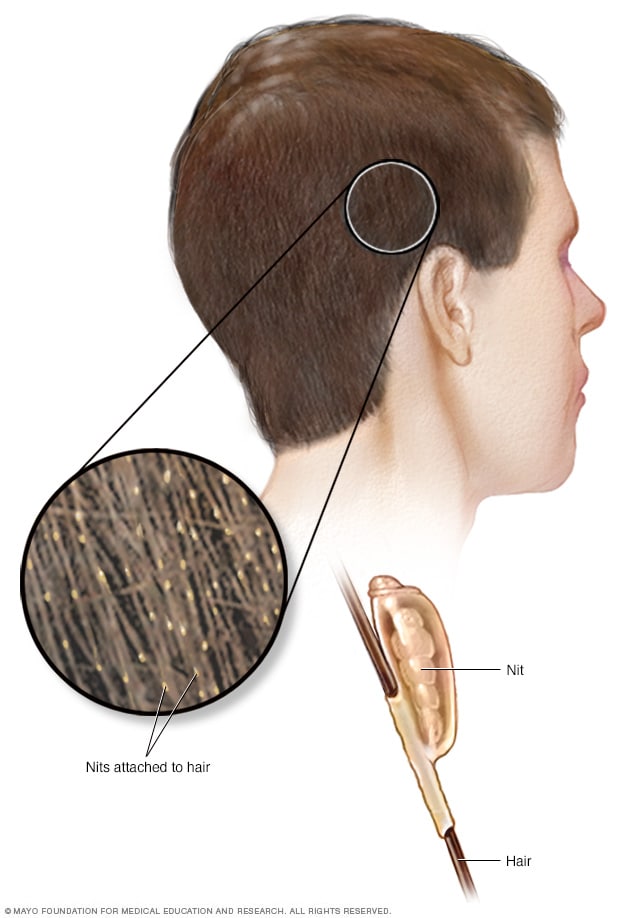 القمل الأعراض والأسباب mayo clinic مايو كلينك
