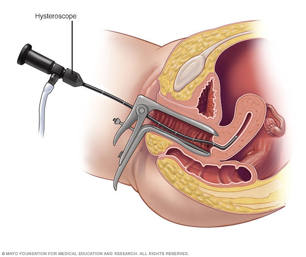 التوسيع والكحت D Amp C Mayo Clinic