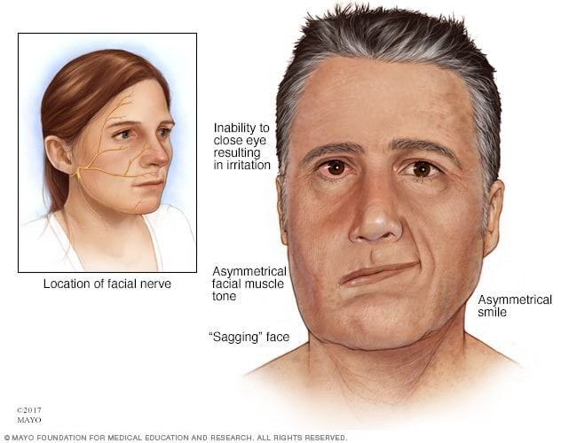 شلل الوجه Mayo Clinic مايو كلينك