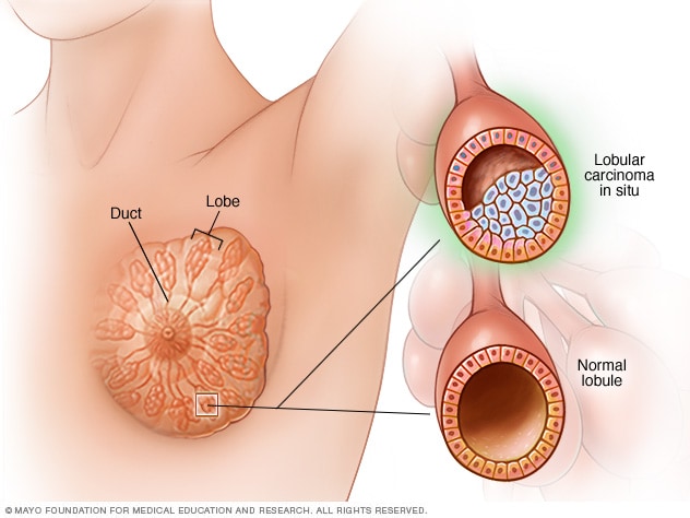 سرطان المصاصة الموضعي (LCIS) الأعراض والأسباب Mayo Clinic (مايو كلينك)