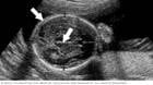 التصوير بالموجات فوق الصوتية يعرض رأس الجنين