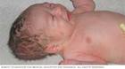 رأس مخروطي الشكل لطفل حديث الولادة