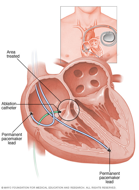 حالة القلب في أثناء استئصال العقدة الأذينية البطينية