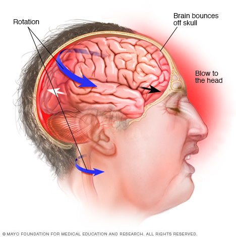 هزة مفاجئة تحرك الدماغ داخل الرأس.