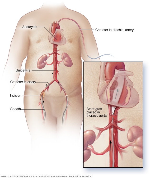 رسم توضيحي يُبَيّن الإصلاح داخل الأوعية الدموية لتمدد الأوعية الدموية الأبهري الصدري
