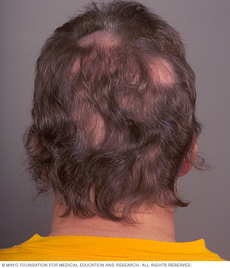 أحيانًا ما يسبق تساقط الشعر الذي يتخذ شكل بقع (الثعلبة البقعية) حكة أو ألم في فروة الرأس.