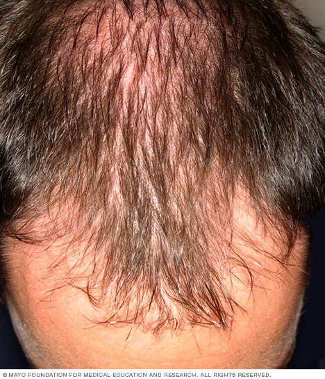 عادةً ما يبدأ الشعر في الانحسار من الجبهة عند الرجال.