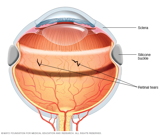تحزيم صُلبة العين لعلاج انفصال الشبكية