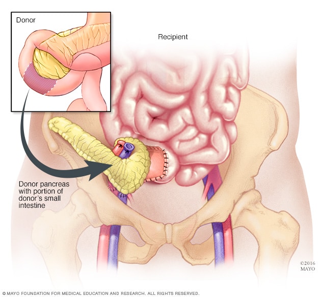 زراعة البنكرياس في Mayo Clinic
