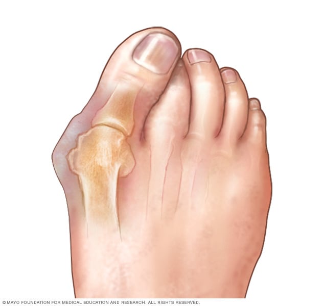علاج مسمار القدم الداخلي