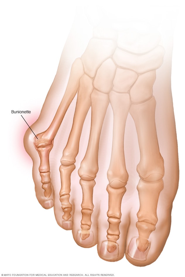الوكعات الأعراض والأسباب Mayo Clinic مايو كلينك