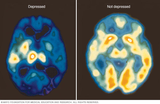 صور للتصوير المقطعي بالإصدار البوزيتروني (PET) توضح النشاط الطبيعي للدماغ (على الجهة اليمنى) وانخفاض نشاط الدماغ نتيجة للاكتئاب (على الجهة اليسرى) 
