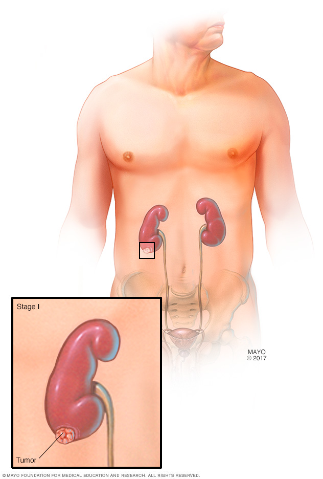 سرطان الكلى التشخيص والعلاج mayo clinic مايو كلينك