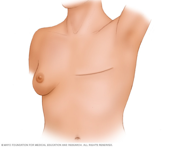 شخص خضع لاستئصال ثدي كلي (بسيط) من دون إعادة بناء للثدي