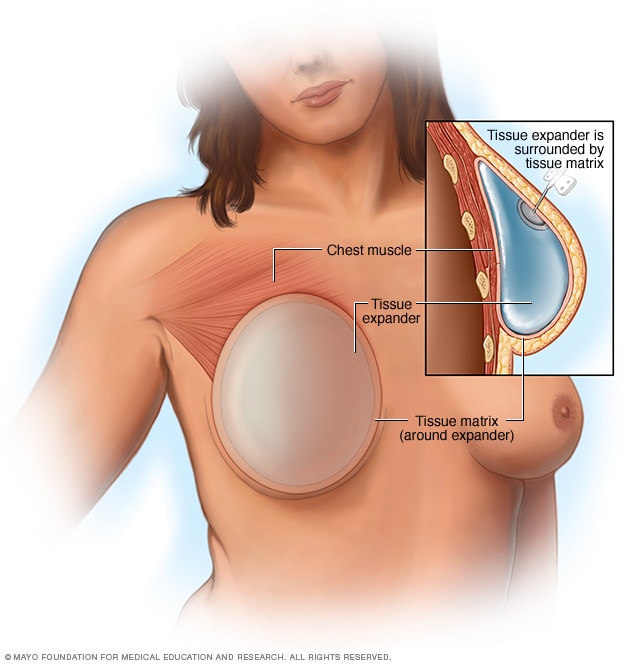 إعادة بناء الثدي بغرسة الثدي الموضوعة أعلى عضلة الصدر