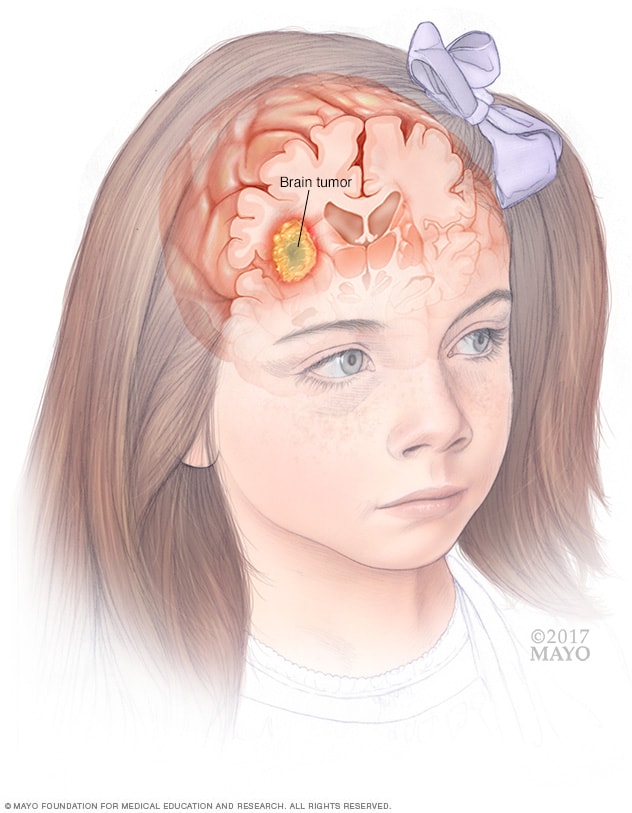 أورام الدماغ لدى الأطفال الأعراض والأسباب mayo clinic مايو كلينك