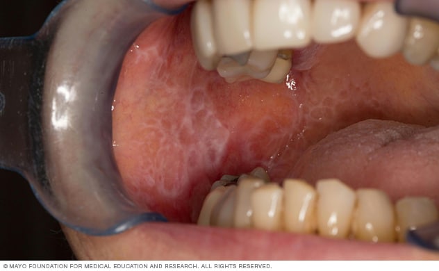 تسبب آفات الحزاز المسطح في الفم رقع بيضاء شريطية في الفم.