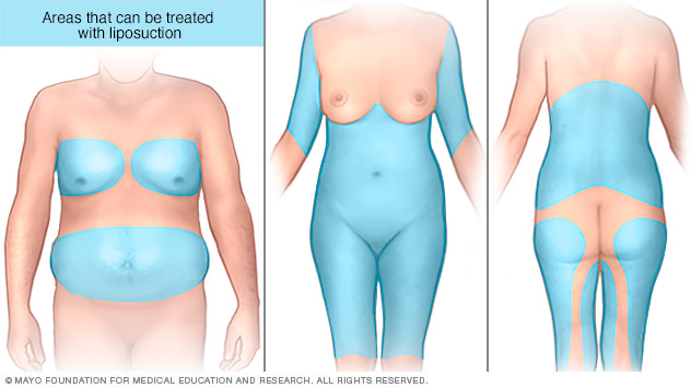 المناطق في البطن والصدر والظهر والساقين والذراعين، والتي يمكن علاجها بشفط الدهون.