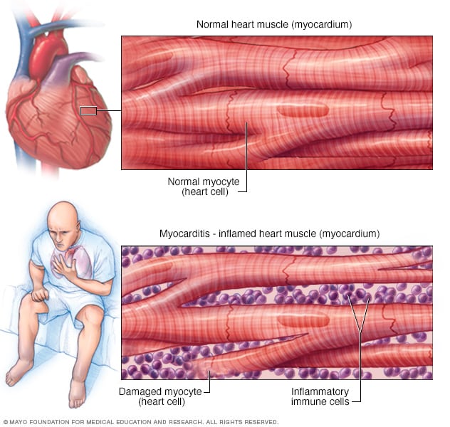 التهاب عضلة القلب الأعراض والأسباب Mayo Clinic مايو كلينك