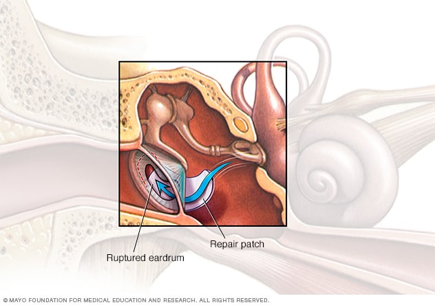 تمزق طبلة الأذن طبلة الأذن المثقوبة التشخيص والعلاج Mayo Clinic مايو كلينك