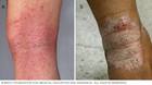 يظهر التهاب الجلد التأتبي غالبًا بين ثنيات الجلد.