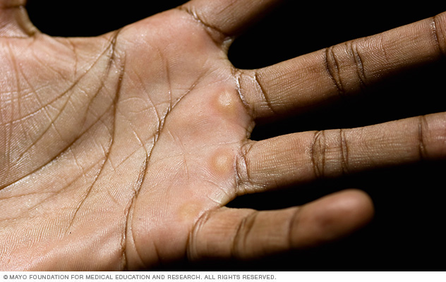 Calluses are usually larger than corns, as with these calluses on the palm.