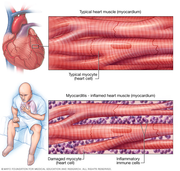 Illustration of inflammation of the heart muscle.