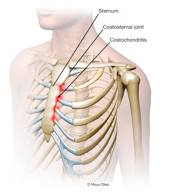 Anyone else got pain under left breast like this and it radiates across to  right : r/costochondritis