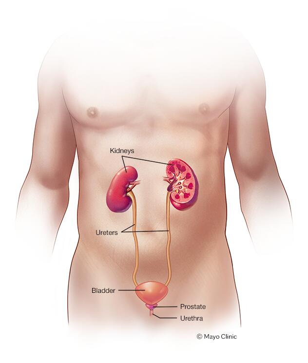 What Causes Bladder Stones and How Are They Treated?