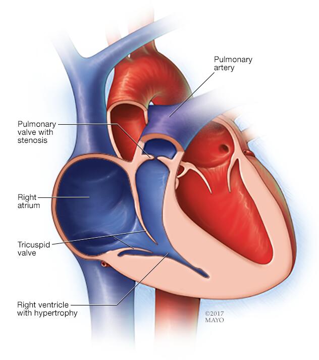 Right And Left Pulmonary Arteries