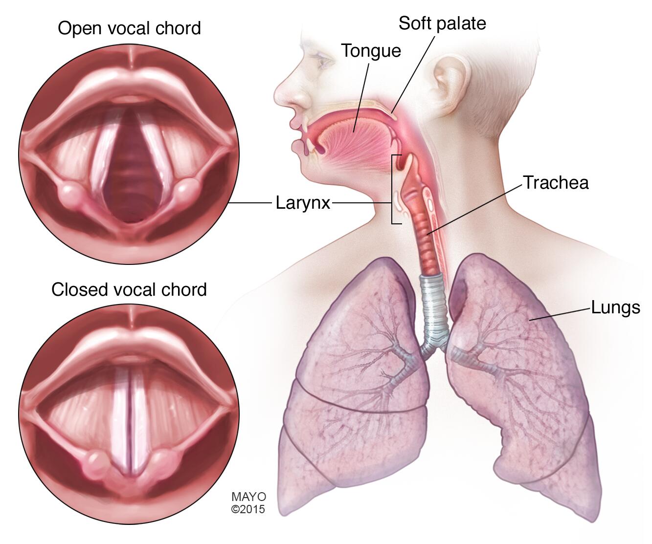 Nursing Paper Example on Laryngitis [SOLVED]