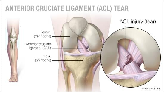 Líquido en la rodilla: Causas, Síntomas y Tratamiento