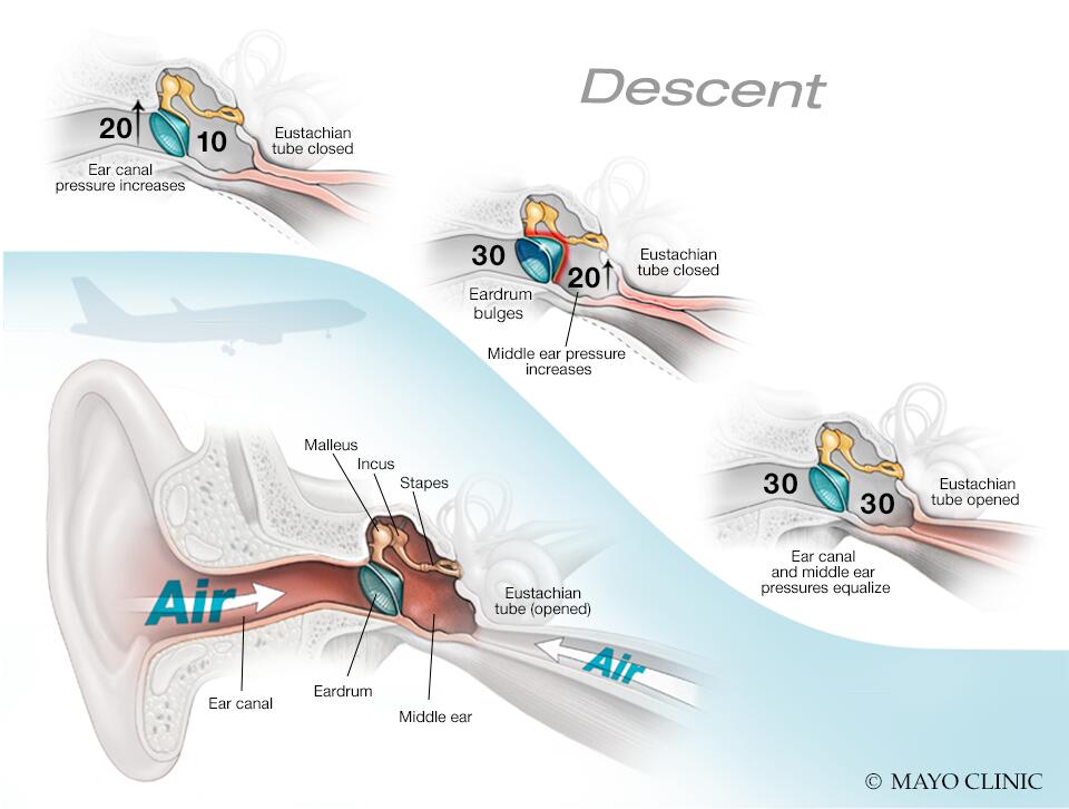 Airplane ear Symptoms & causes - Mayo