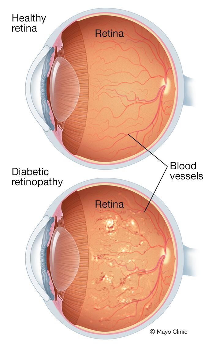 Understanding Retinopathy Symptoms: What to Look Out For
