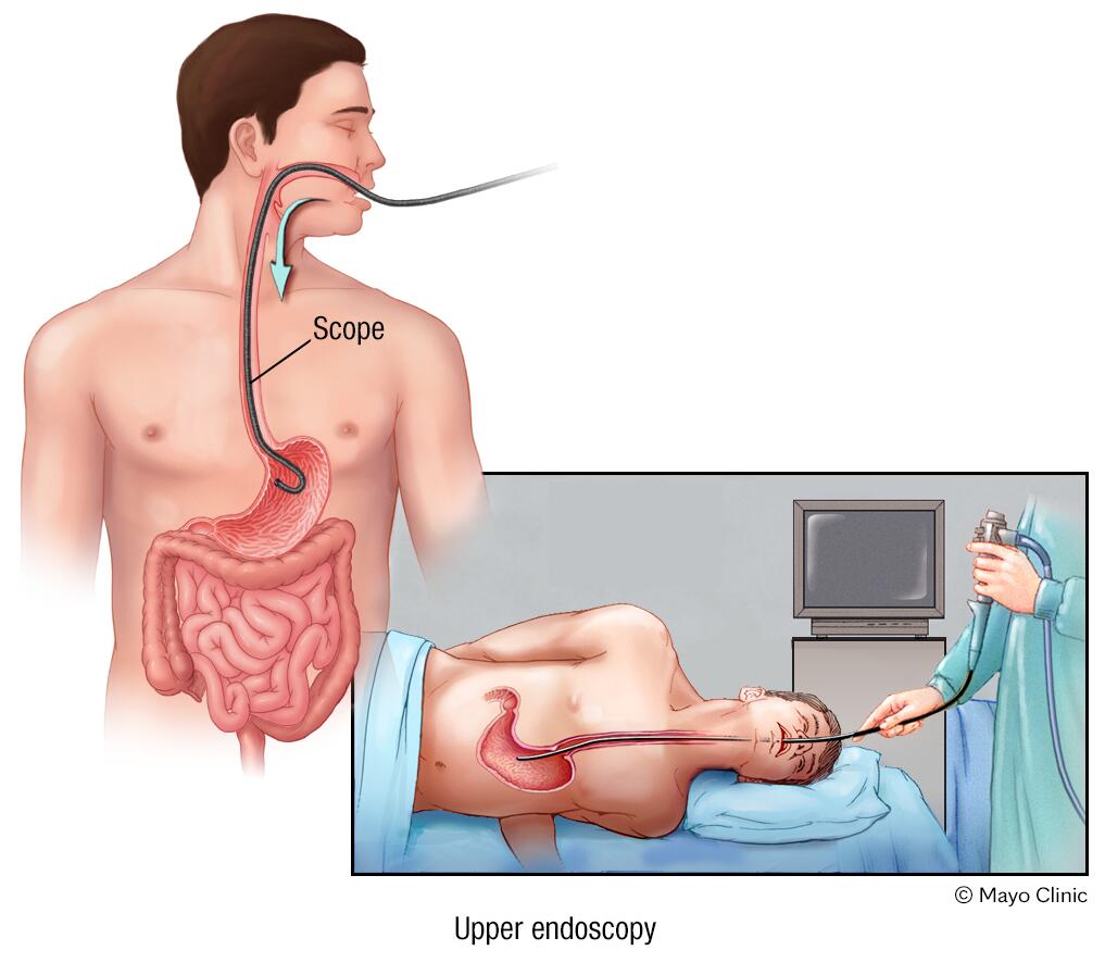 Aloe vera juice acid reflux mayo clinic 2025