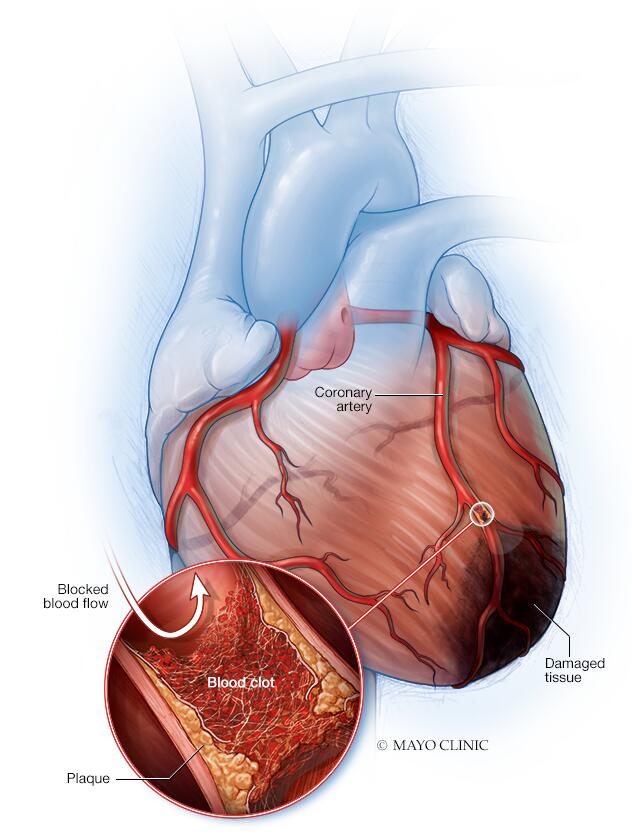 diseased human heart