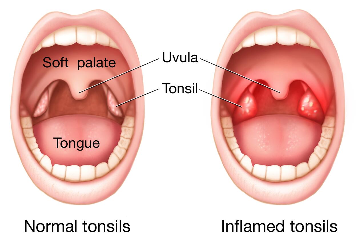 Swollen Tonsils Tonsillitis Symptoms Causes And More 51 OFF