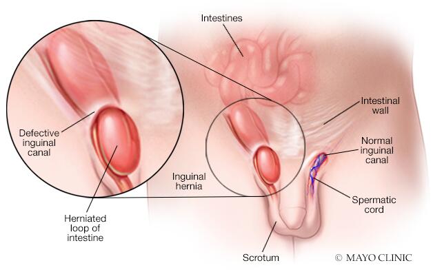 Large Right Inguinal Hernia