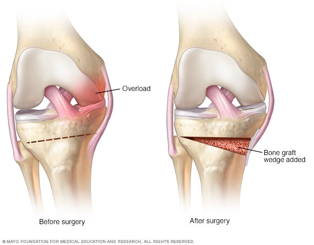 https://www.mayoclinic.org/content/dam/media/en/images/2023/02/09/knee-osteotomy.jpg