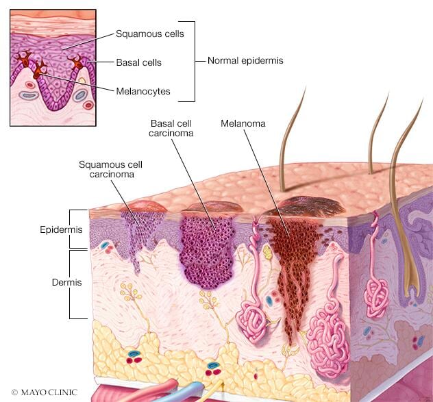 Basal cell carcinoma - Symptoms & causes - Mayo Clinic