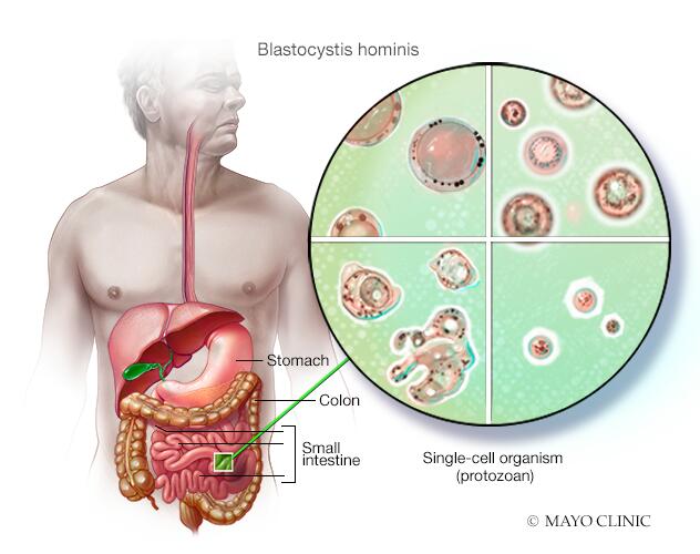 Blastocystis hominis - Symptoms & causes - Mayo Clinic